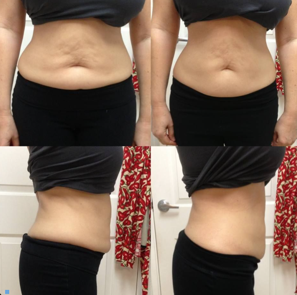 Gel reductor ReduFit Ultra🔥¡Pierde tallas desde la primera semana!