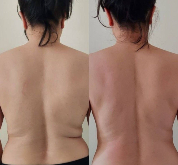Gel reductor ReduFit Ultra🔥¡Pierde tallas desde la primera semana!
