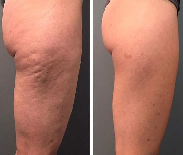 Gel reductor ReduFit Ultra🔥¡Pierde tallas desde la primera semana!