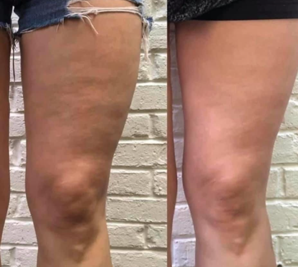 Gel reductor ReduFit Ultra🔥¡Pierde tallas desde la primera semana!